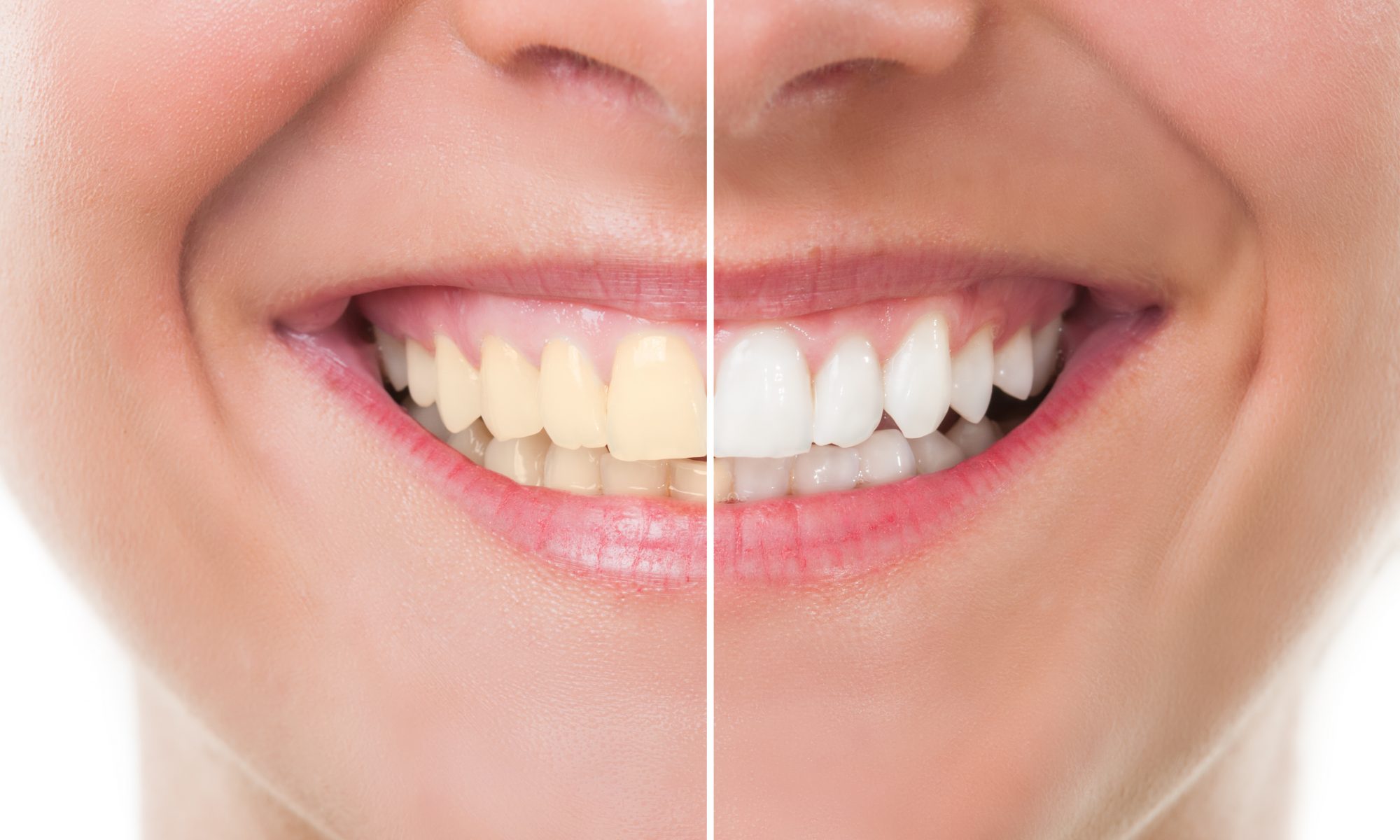 teeth whitening