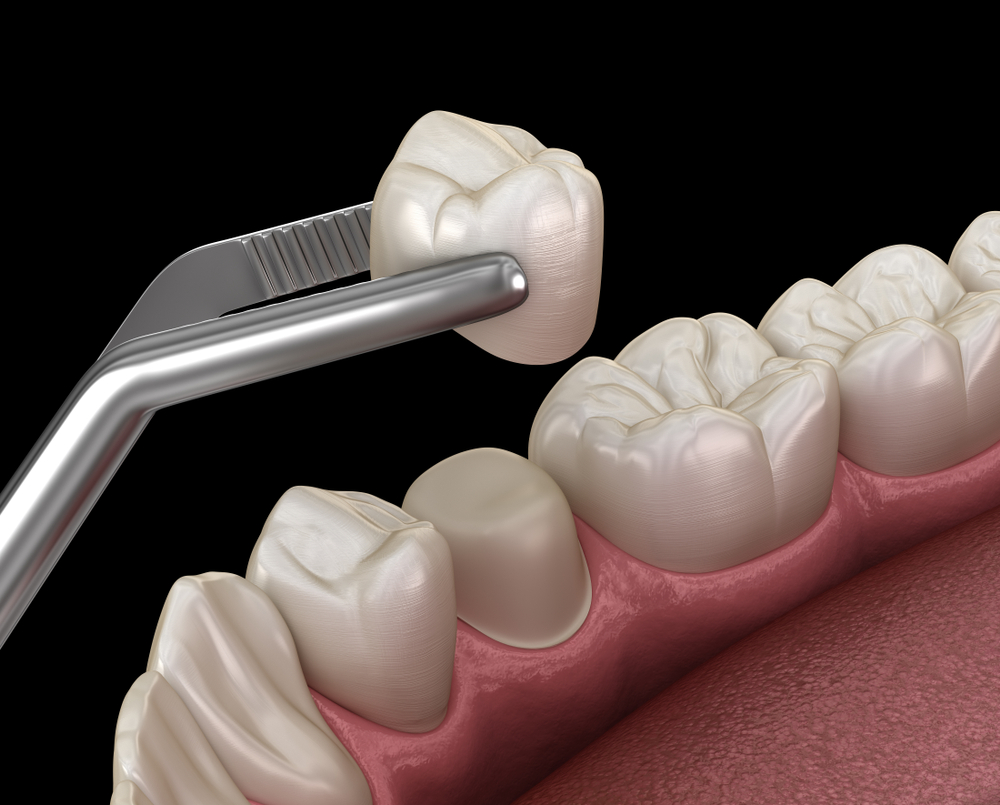 dental crowns