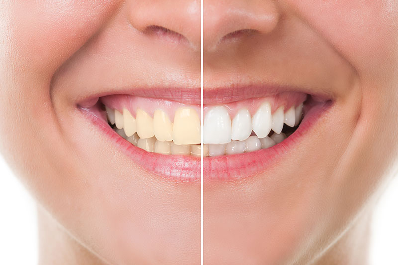 Teeth Whitening - Columbus Family Dentistry, Bakersfield Dentist